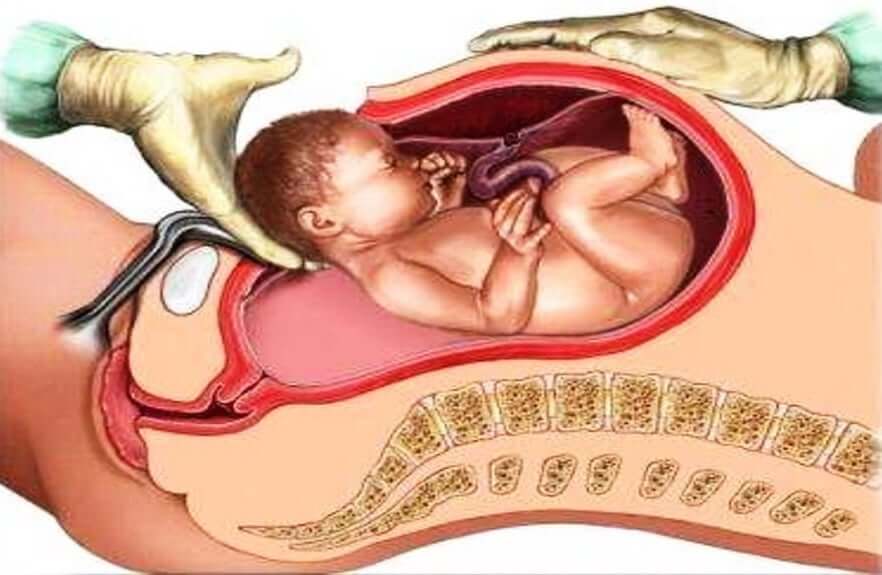 sezayen doğum sonrası bilgi