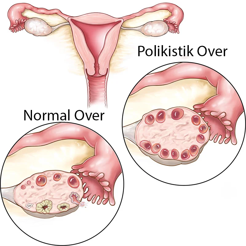 polikistik-over polikistik over sendromu