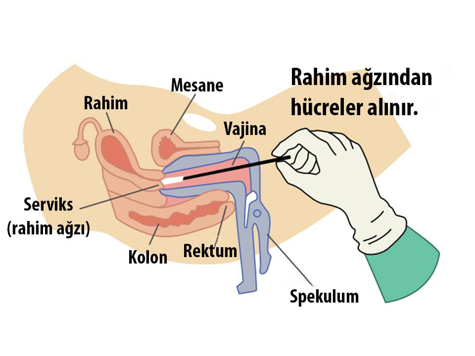 HPV testi nasıl yapılır
