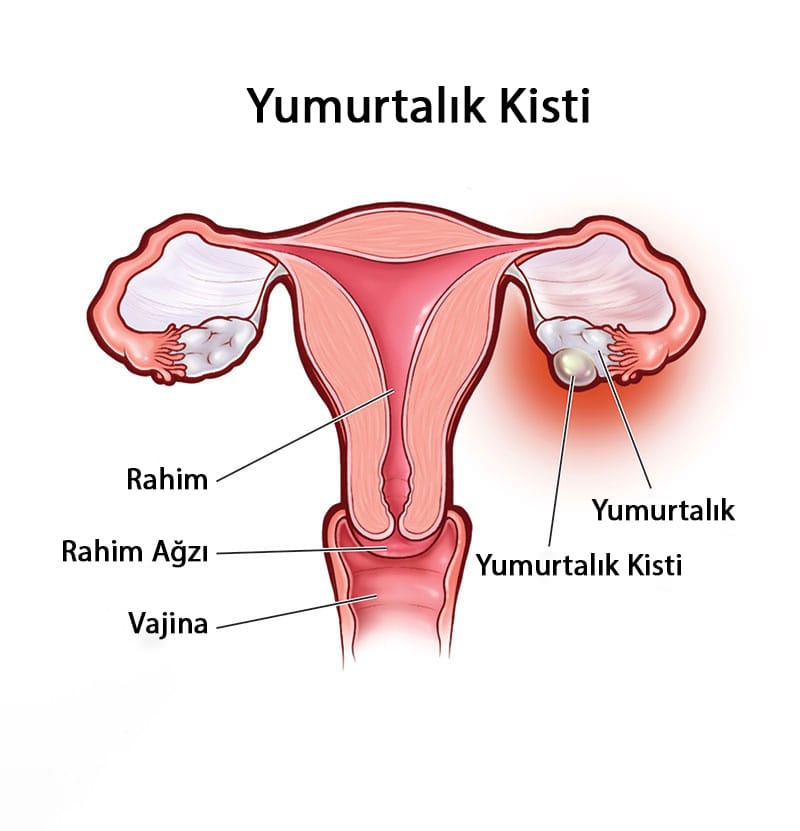 yumurtalık kisti
