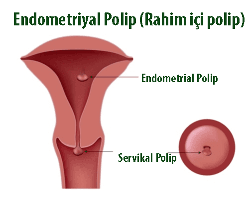 endometrial polip