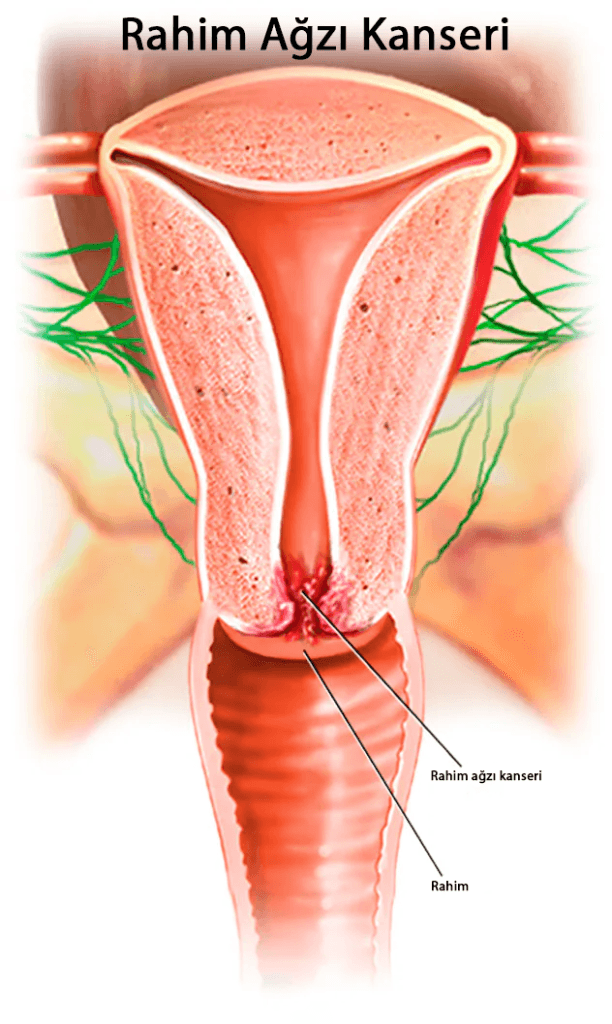 rahim ağzı kanseri belirtileri