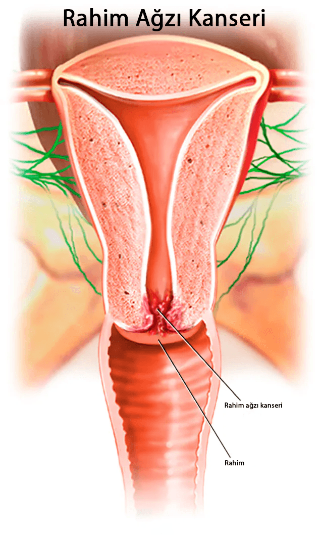 rahim ağzı kanseri belirtileri