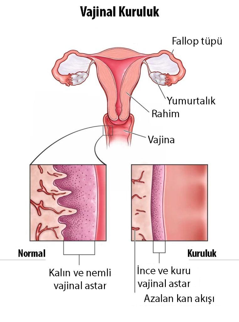 vajinal kuruluk neden olur